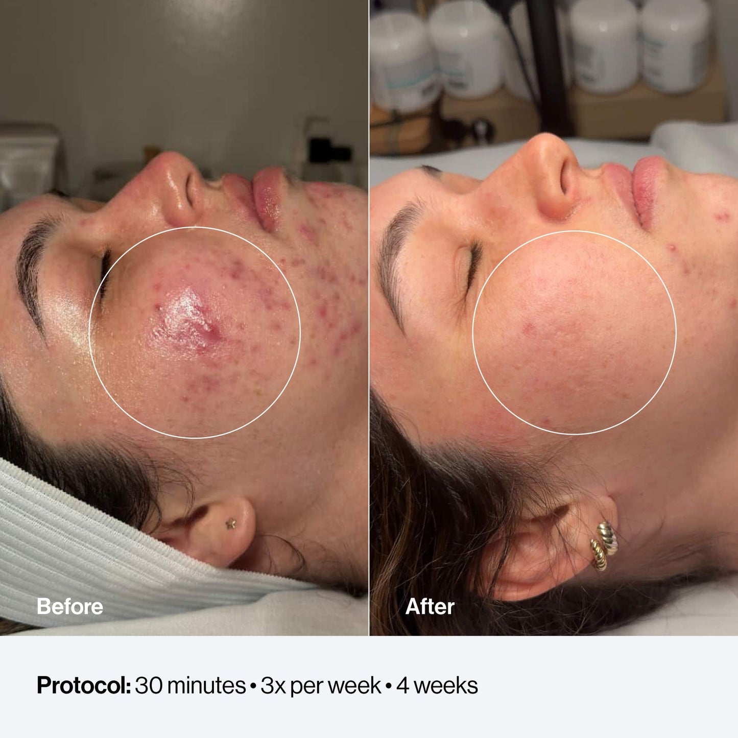 Celluma FACE LED Light Therapy Device