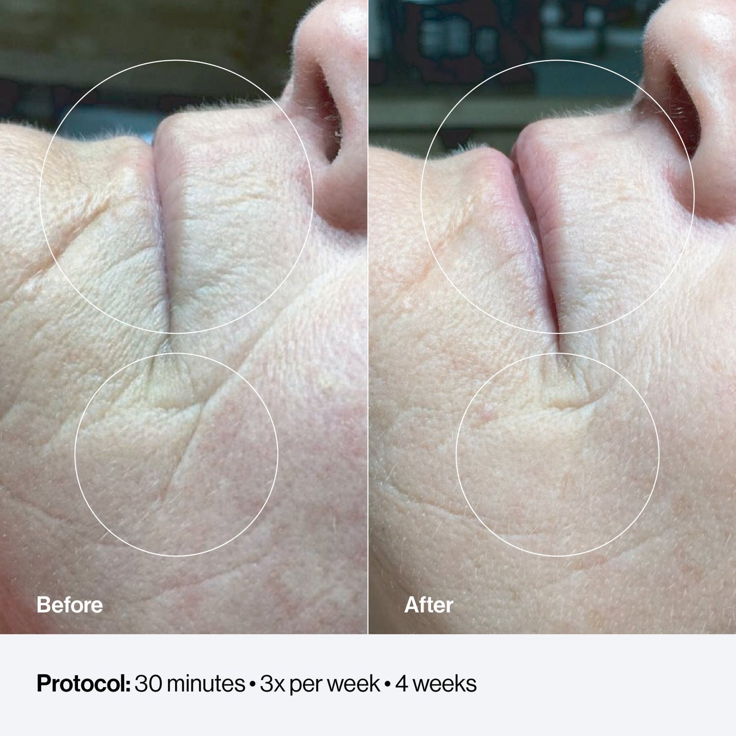 Celluma FACE LED Light Therapy Device