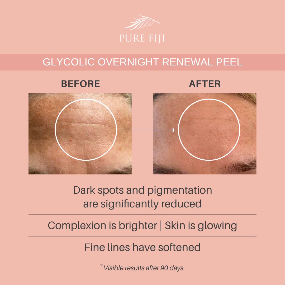 Pure Fiji Glycolic Overnight Renewal Peel with Mandelic + Niacinamide (1oz/30ml)