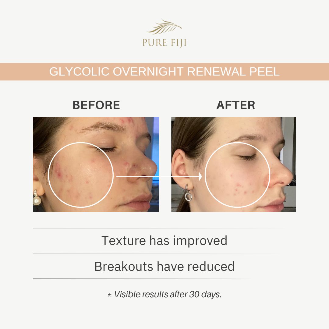 Pure Fiji Glycolic Overnight Renewal Peel with Mandelic + Niacinamide (1oz/30ml)